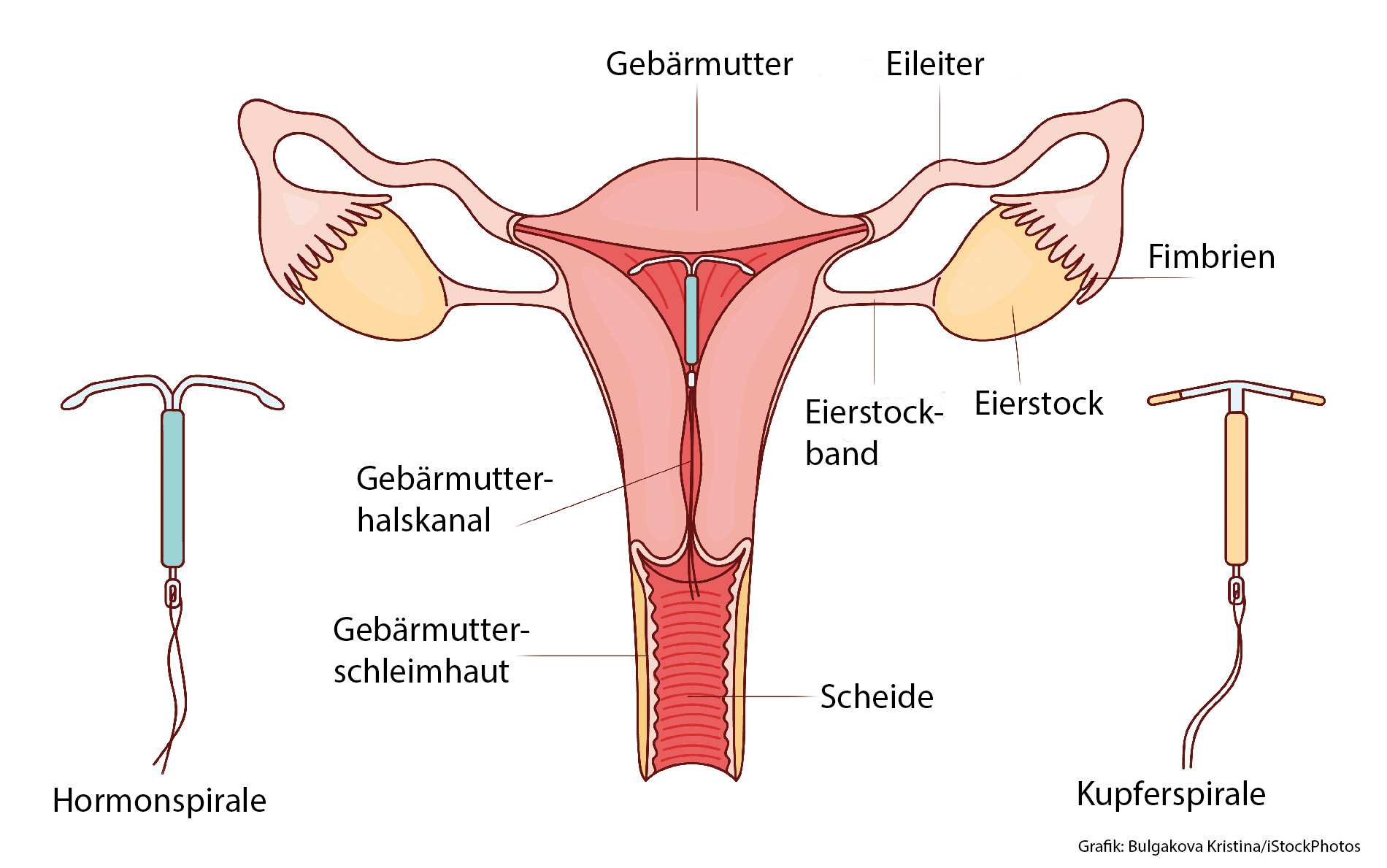 Schematische Darstellung des weiblichen Fortpflanzungssystems mit Gebärmutter, Eileitern, Eierstöcken, Gebärmutterhalskanal, Vagina sowie Hormon- und Kupferspirale als Verhütungsmethoden.