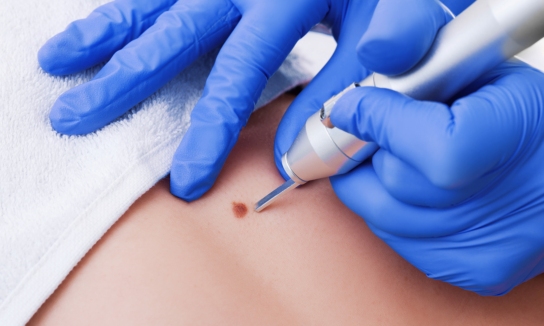 Fibrom auf der Haut wird mit einem silbernen Zylinder behandelt, aus dem flüssiger Stickstoff kommt