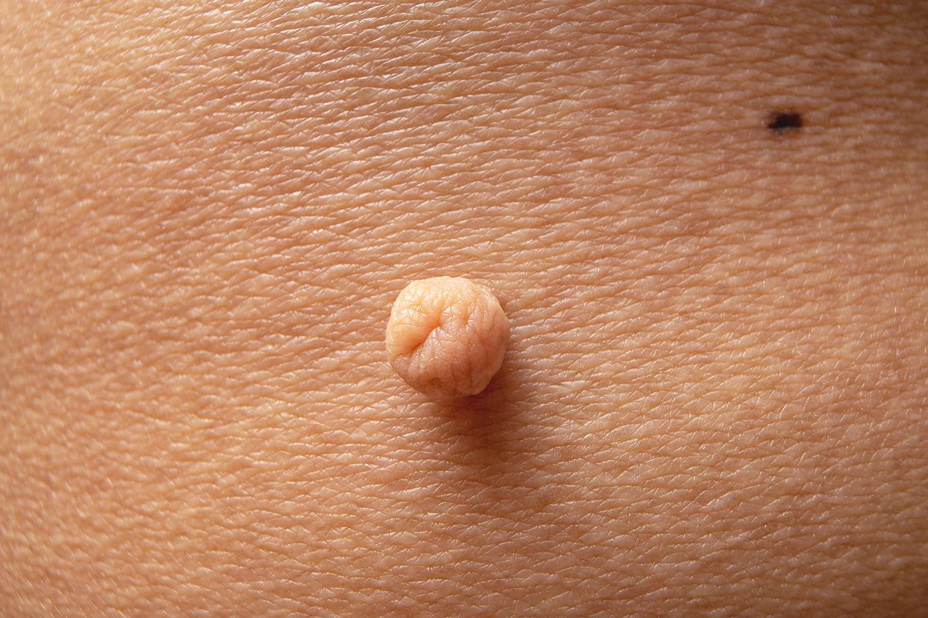 Fibrom in Nahaufnahme