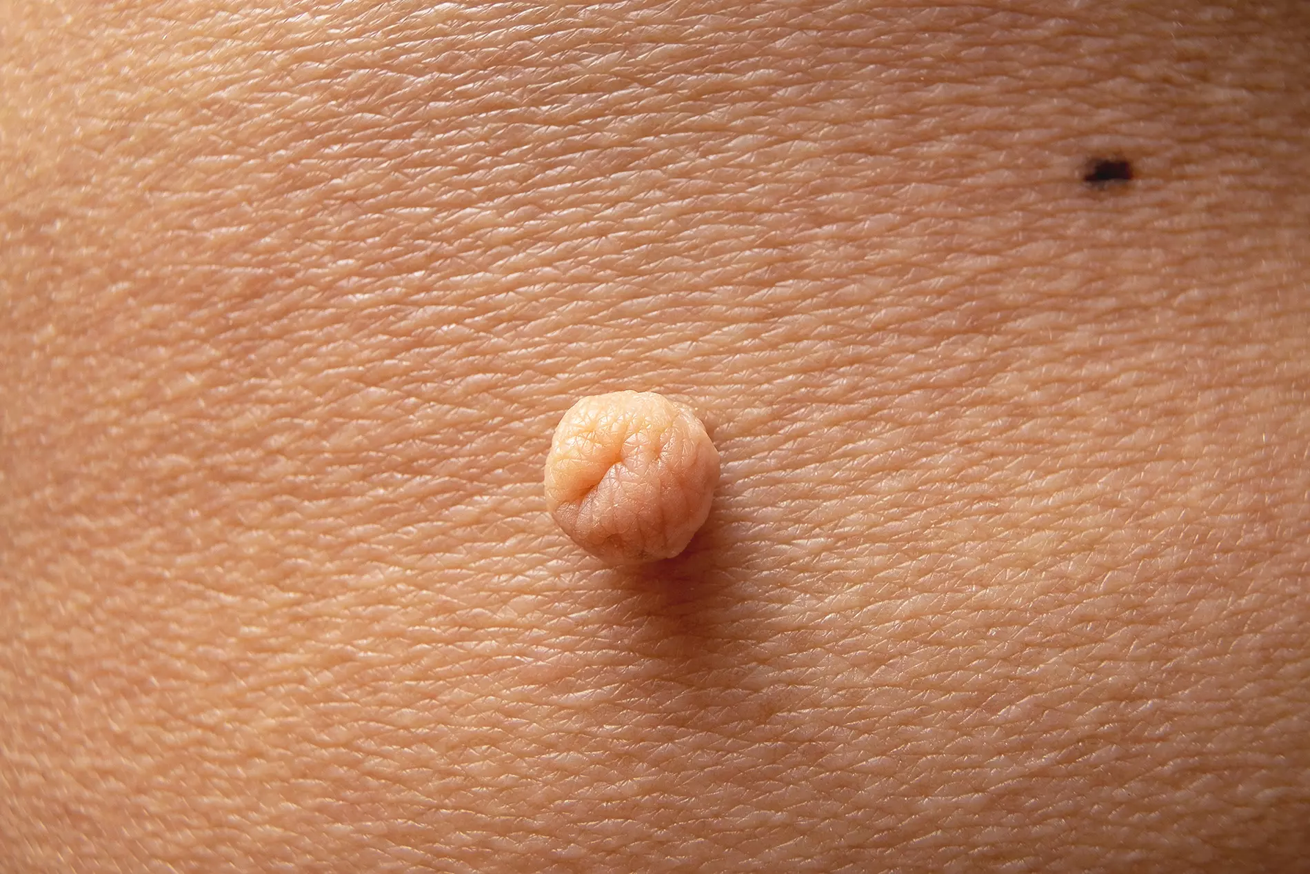 Fibrom in Nahaufnahme