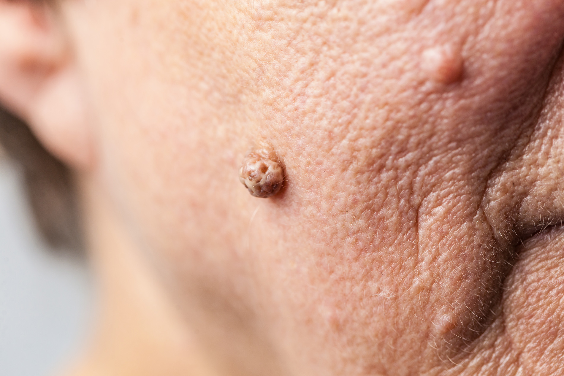 Fibrom auf der Haut einer älteren Frau
