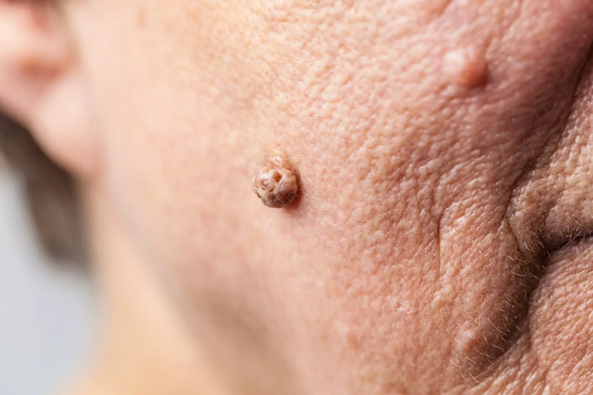 Fibrom auf der Haut einer älteren Frau