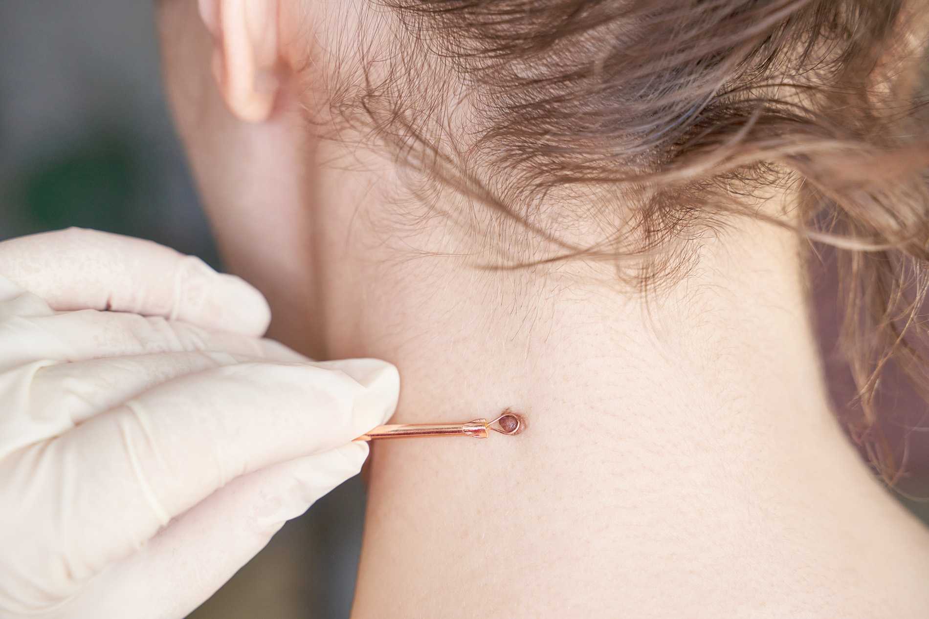 Hautunregelmässigkeit am Hals einer Patientin