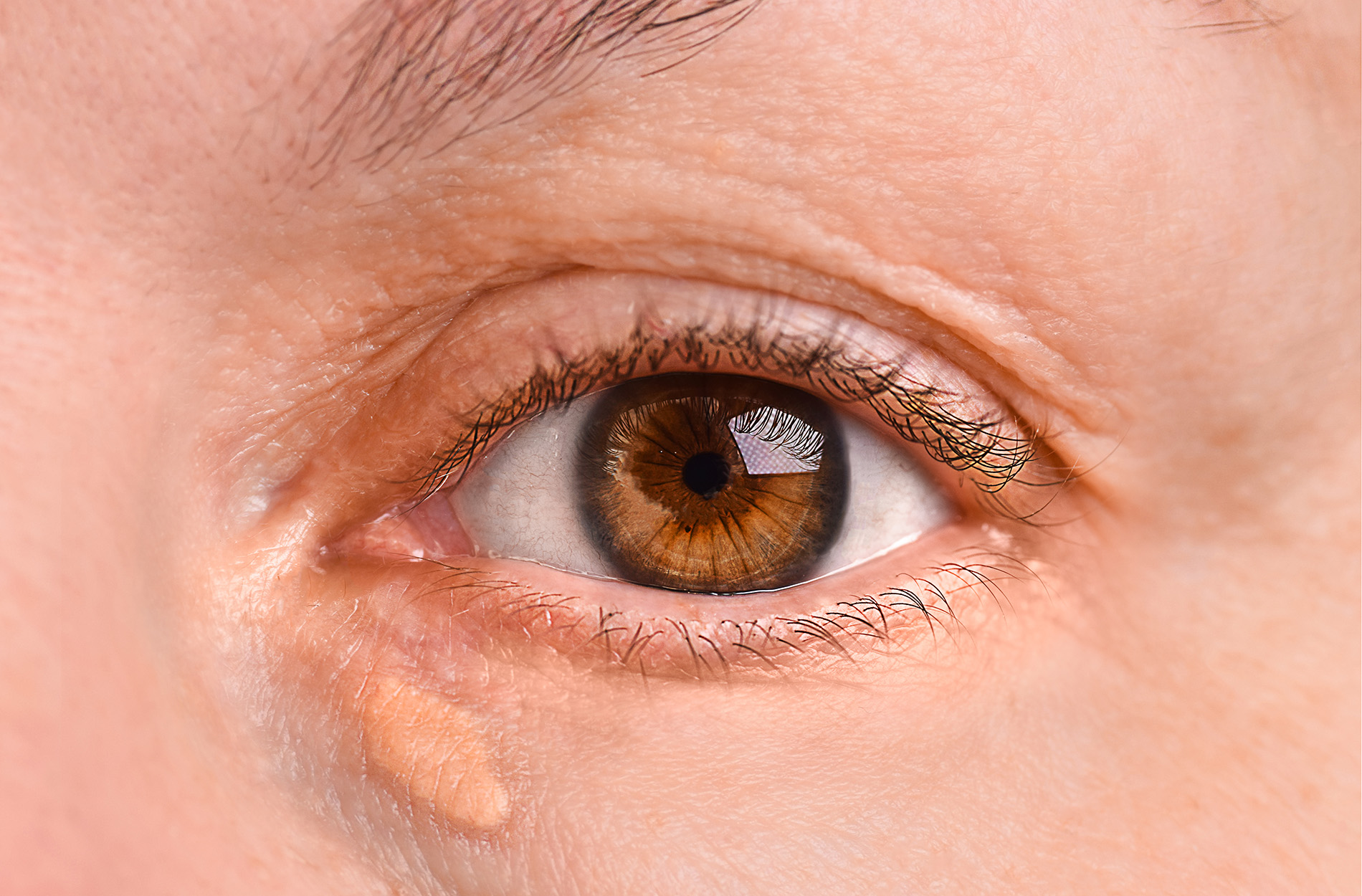 Xanthelasma unter einem Auge einer Frau