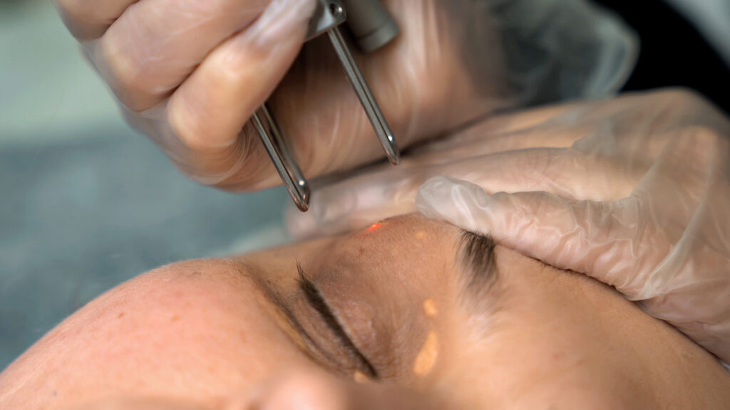 Die Haut rund um das Auge einer Frau wird mit dem Laser behandelt