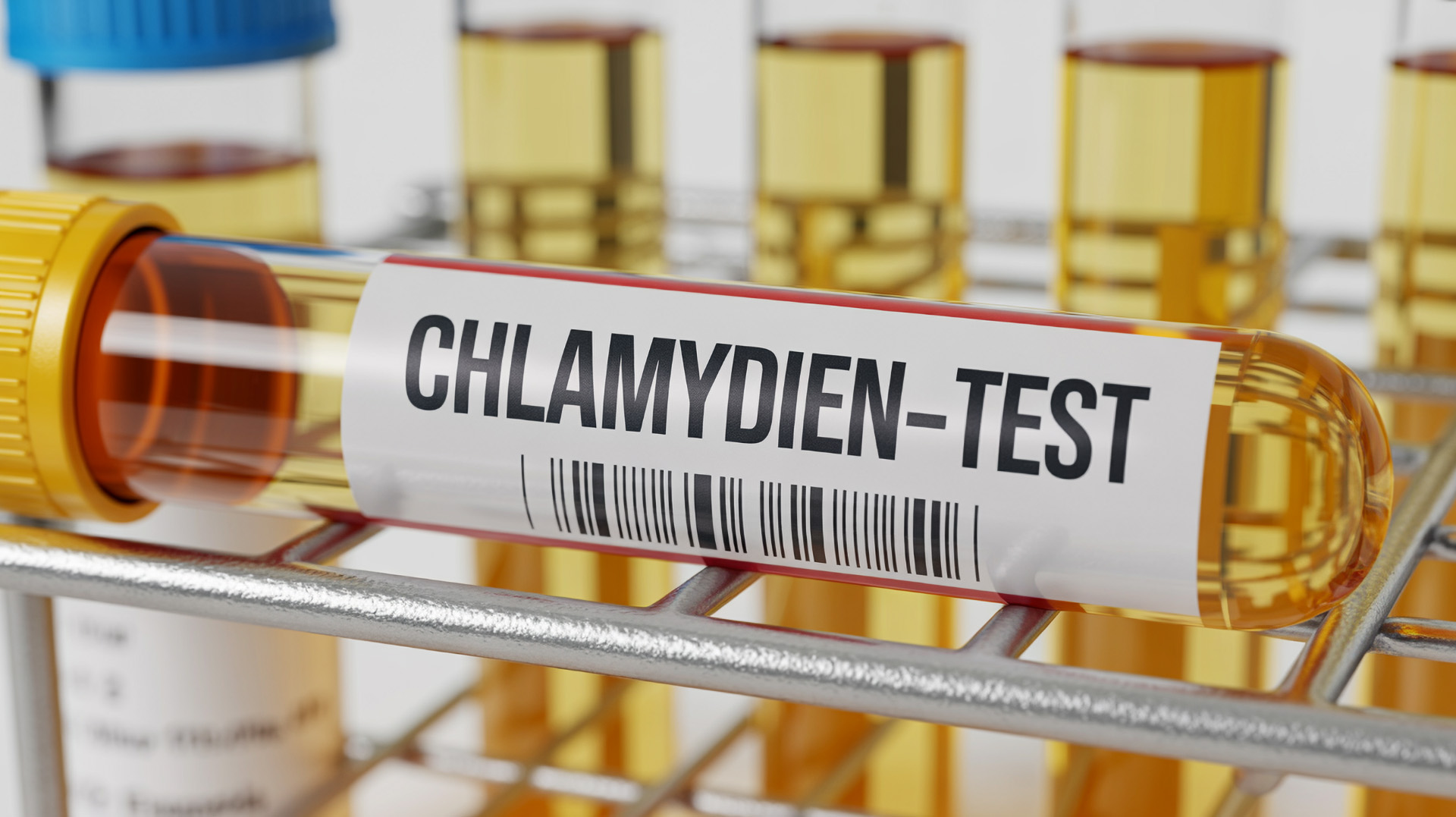 Urinprobe für Chlamydien-Test mit deutlicher Beschriftung